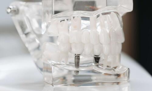 All-on-4® vs. klassisches Implantat: Welche Versorgung passt zu Ihnen?