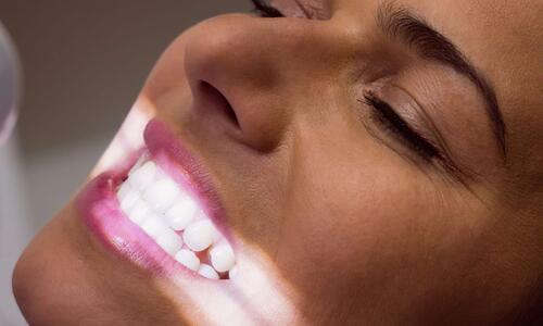 Professionelles Bleaching oder reicht 