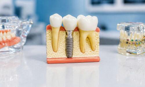 Keramikimplantat vs. Titanimplantat: Vor- und Nachteile im Vergleich